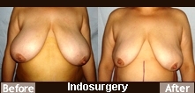 breast-reduction-liposuction-indosurgery-mumbai-india