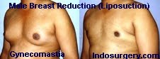 gynecomastia-surgery-mumbai-india-delhi-indosurgery.com