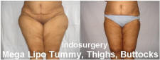 mega-liposuction-tummy-thighs-buttocks-indosurgery